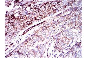 Immunohistochemical analysis of paraffin-embedded bladder cancer tissues using CD59 mouse mAb with DAB staining. (CD59 anticorps  (AA 31-111))