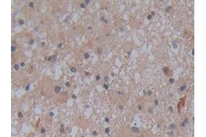 Detection of ALPL in Human Glioma Tissue using Polyclonal Antibody to Alkaline Phosphatase, Tissue-nonspecific (ALPL)