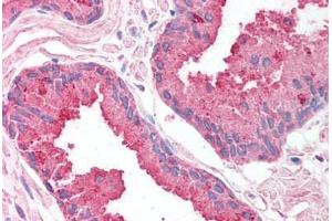 Human Prostate (formalin-fixed, paraffin-embedded) stained with SAP18 antibody ABIN214141 at 5 ug/ml followed by biotinylated goat anti-rabbit IgG secondary antibody ABIN481713, alkaline phosphatase-streptavidin and chromogen.