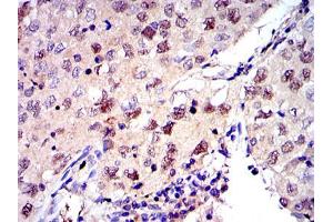 Immunohistochemical analysis of paraffin-embedded lung cancer tissues using MCM2 mouse mAb with DAB staining. (MCM2 anticorps)