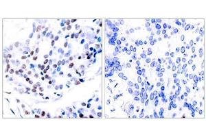 Immunohistochemical analysis of paraffin-embedded human breast carcinoma tissue using c-Jun (Ab-239) antibody (E021024). (C-JUN anticorps)