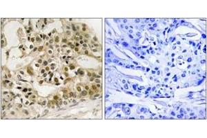 Immunohistochemistry analysis of paraffin-embedded human breast carcinoma, using Myb (Phospho-Ser532) Antibody. (MYB anticorps  (pSer532))