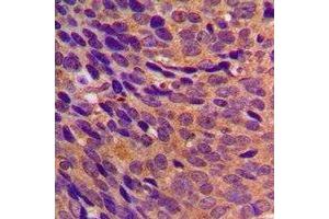 Immunohistochemical analysis of CBR3 staining in human breast cancer formalin fixed paraffin embedded tissue section.