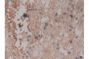 Detection of CYLD in Human Glioma Tissue using Polyclonal Antibody to Cylindromatosis (CYLD)