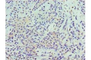 Immunohistochemistry of paraffin-embedded human breast cancer using ABIN7169685 at dilution of 1:100