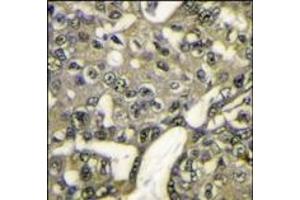 Formalin-fixed and paraffin-embedded human breast carcinoma reacted with AKT1 antibody (N-term), which was peroxidase-conjugated to the secondary antibody, followed by DAB staining