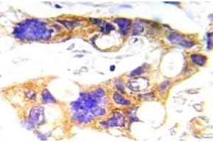 Immunohistochemistry (IHC) analyzes of p-c-RAF antibody in paraffin-embedded human prostate carcinoma tissue. (NCOA1 anticorps  (pTyr529))