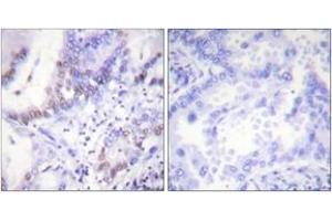 Immunohistochemistry analysis of paraffin-embedded human lung carcinoma, using Abl (Phospho-Tyr412) Antibody. (ABL1 anticorps  (pTyr393))