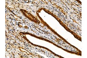 ABIN6259116 and ABIN6274466 at 1/100 staining Human ovarian cancer and adjacent normal tissues by IHC-P. (MKL1 anticorps  (N-Term))