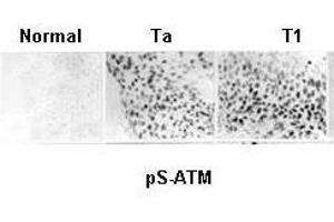 Anti-ATM Monoclonal Antibody - Immunohistochemistry Anti ATM monoclonal Antibody was used to show constitutive activation of the ATM pathway in human urinary bladder cancer. (ATM anticorps  (AA 1974-1988))