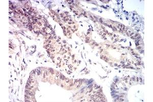 Immunohistochemical analysis of paraffin-embedded colon cancer tissues using KAT7 mouse mAb with DAB staining.