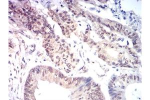 Immunohistochemical analysis of paraffin-embedded colon cancer tissues using KAT7 mouse mAb with DAB staining. (MYST2 anticorps  (AA 1-200))