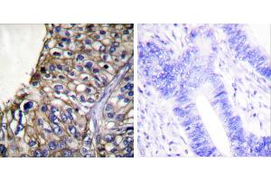 Peptide - +Immunohistochemical analysis of paraffin-embedded human lung carcinoma tissue using Claudin 7 antibody (#C0153). (Claudin 7 anticorps)