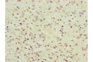 Immunohistochemistry of paraffin-embedded human glioma using ABIN7166519 at dilution of 1:100 (PCDHA12 anticorps  (AA 862-941))