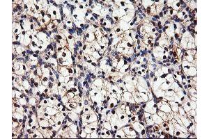 Immunohistochemical staining of paraffin-embedded Carcinoma of Human kidney tissue using anti-DPP9 mouse monoclonal antibody.