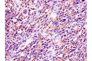 Immunohistochemistry of paraffin-embedded human glioma using ABIN7173542 at dilution of 1:100 (C22orf28 anticorps  (AA 52-229))
