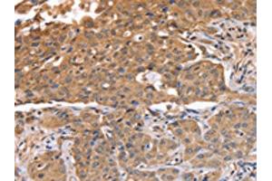 The image on the left is immunohistochemistry of paraffin-embedded Human lung cancer tissue using ABIN7128119(ABCB6 Antibody) at dilution 1/15, on the right is treated with fusion protein. (ABCB6 anticorps)