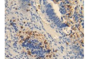 IHC-P analysis of Human Colorectal cancer Tissue, with DAB staining. (OTC anticorps  (AA 78-129))