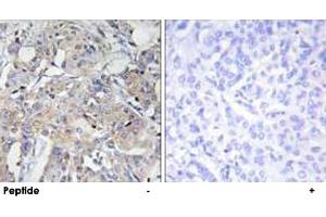 Immunohistochemistry analysis of paraffin-embedded human breast carcinoma tissue using COL6A3 polyclonal antibody . (COL6a3 anticorps  (AA 2261-2310))