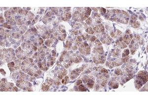 ABIN6273303 at 1/100 staining Human pancreas cancer tissue by IHC-P. (RAB12 anticorps  (C-Term))