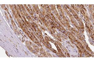 ABIN6267126 at 1/100 staining Human thyroid cancer tissue by IHC-P. (EIF3B anticorps  (pSer154))