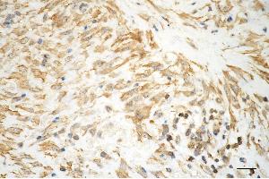 Immunohistochemistry was performed on paraffin-embedded human hepatocarcinoma using aggrecan antibody (ABIN7797541), 1:200). (Recombinant Aggrecan anticorps)