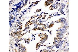 IHC-P: Beta Arrestin 2 antibody testing of human intestinal cancer tissue (Arrestin 3 anticorps  (C-Term))