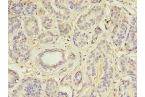 Immunohistochemistry of paraffin-embedded human breast cancer using ABIN7159004 at dilution of 1:100 (MAP3K7CL anticorps  (AA 1-142))