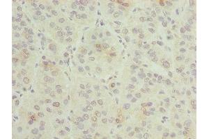 Immunohistochemistry of paraffin-embedded human liver cancer using ABIN7154676 at dilution of 1:100 (GNG5 anticorps  (AA 2-65))