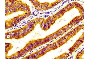 IHC image of ABIN7170335 diluted at 1:600 and staining in paraffin-embedded human endometrial cancer performed on a Leica BondTM system.