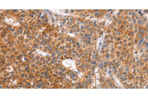 Immunohistochemistry of paraffin-embedded Human liver cancer tissue using ABO Polyclonal Antibody at dilution 1:50 (ABO anticorps)