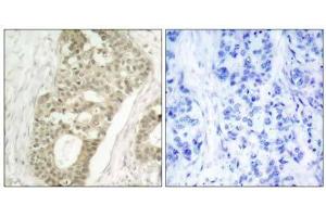 Immunohistochemical analysis of paraffin-embedded human breast carcinoma tissue using PKCδ (phospho- Ser645) antibody (E011296). (PKC delta anticorps  (pSer645))