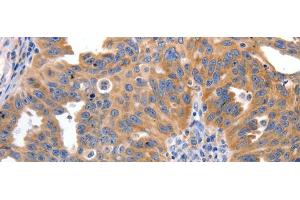 Immunohistochemistry of paraffin-embedded Human ovarian cancer tissue using IRS2 Polyclonal Antibody at dilution 1:100 (IRS2 anticorps)