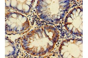 Immunohistochemistry of paraffin-embedded human colon cancer using ABIN7153928 at dilution of 1:100 (GPI anticorps  (AA 2-554))