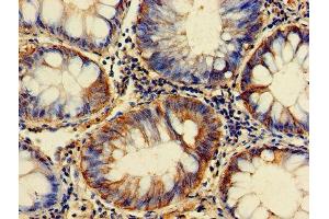 Immunohistochemistry of paraffin-embedded human colon cancer using ABIN7153928 at dilution of 1:100