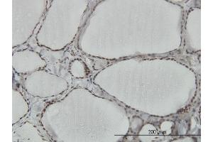 Immunoperoxidase of monoclonal antibody to HNRPM on formalin-fixed paraffin-embedded human thyroid nodular goiter.