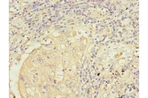 Immunohistochemistry of paraffin-embedded human lung cancer using ABIN7149955 at dilution of 1:100