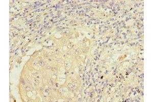 Immunohistochemistry of paraffin-embedded human lung cancer using ABIN7149955 at dilution of 1:100 (FMO2 anticorps  (AA 210-470))