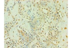 Immunohistochemistry of paraffin-embedded human breast cancer using ABIN7145226 at dilution of 1:100