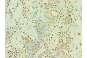 Immunohistochemistry of paraffin-embedded human breast cancer using ABIN7145226 at dilution of 1:100 (BAG5 anticorps  (AA 198-447))