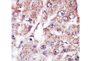 IHC analysis of FFPE human hepatocarcinoma stained with the MARK2 antibody