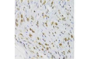 Immunohistochemistry of paraffin-embedded human gastric cancer using DOK1 Antibody (ABIN6130881, ABIN6139763, ABIN6139764 and ABIN6221343) at dilution of 1:100 (40x lens).