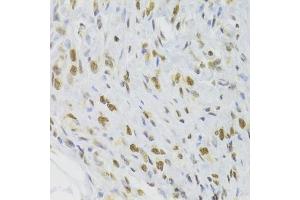 Immunohistochemistry of paraffin-embedded human gastric cancer using DOK1 Antibody (ABIN6130881, ABIN6139763, ABIN6139764 and ABIN6221343) at dilution of 1:100 (40x lens). (DOK1 anticorps  (AA 1-280))