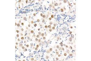 Immunohistochemistry of paraffin-embedded Human testicular seminoma using Nanog Rabbit pAb (ABIN1680964, ABIN3017620, ABIN3017621 and ABIN6220166) at dilution of 1:25 (40x lens). (Nanog anticorps  (AA 1-100))