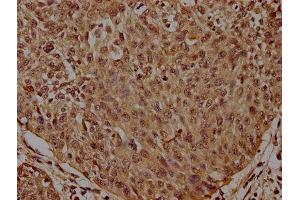 IHC image of ABIN7155407 diluted at 1:300 and staining in paraffin-embedded human cervical cancer performed on a Leica BondTM system. (Histone 2b (HIST1H2BL) (AA 2-126) anticorps)