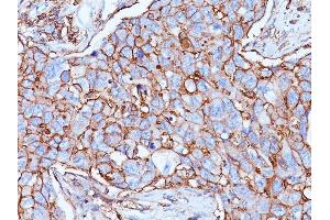 Formalin-fixed, paraffin-embedded human Breast Carcinoma stained with CD44 Mouse Monoclonal Antibody (156-3C11). (CD44 anticorps)