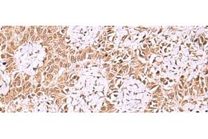 Immunohistochemistry of paraffin-embedded Human ovarian cancer tissue using IRX1 Polyclonal Antibody at dilution of 1:35(x200) (IRX1 anticorps)