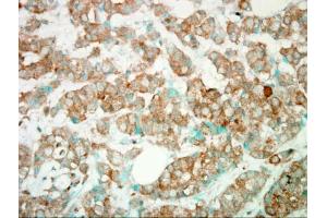 IHC-P Image Immunohistochemical analysis of paraffin-embedded Human Breast Cancer, using PI3K gamma, antibody.