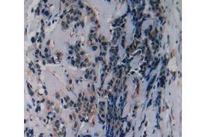 Used in DAB staining on fromalin fixed paraffin- embedded breast cancer tissue