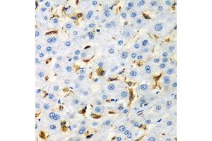 Immunohistochemistry of paraffin-embedded human liver injury using CD68 antibody at dilution of 1:200 (40x lens). (CD68 anticorps)
